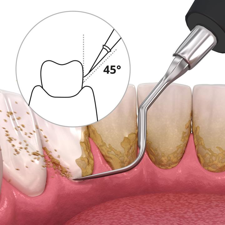 Actual product image Ailoria Deplaqued (Sonic tooth cleaner)