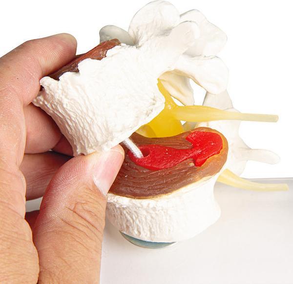 Image du produit Erler Zimmer Modèle anatomique Stades de la lésion discale