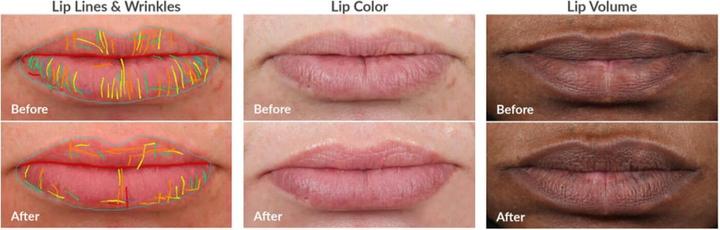 Produktbild PMD Kiss Lip Plumping System