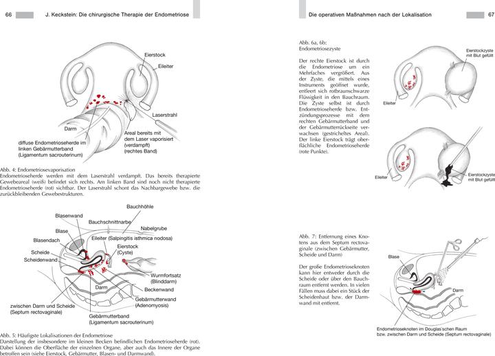 Produktbild Endometriose - Die verkannte Frauenkrankheit (Deutsch, Johanna Wolf, Prof. Dr. med. Jörg Keckstein, Dr. med. Anja Maria Engelsing, Prof. Dr. med. Gerhard Leyendecker, 2019)