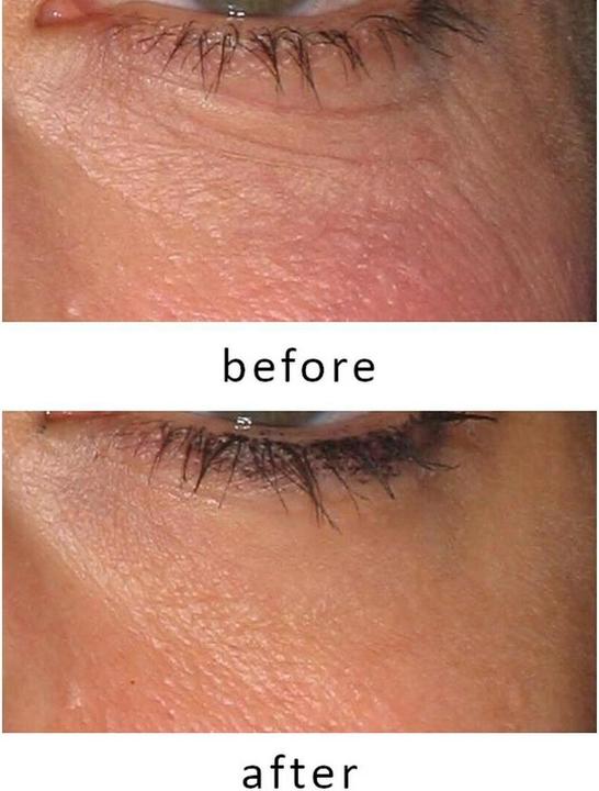 Image du produit Silk'n Revive