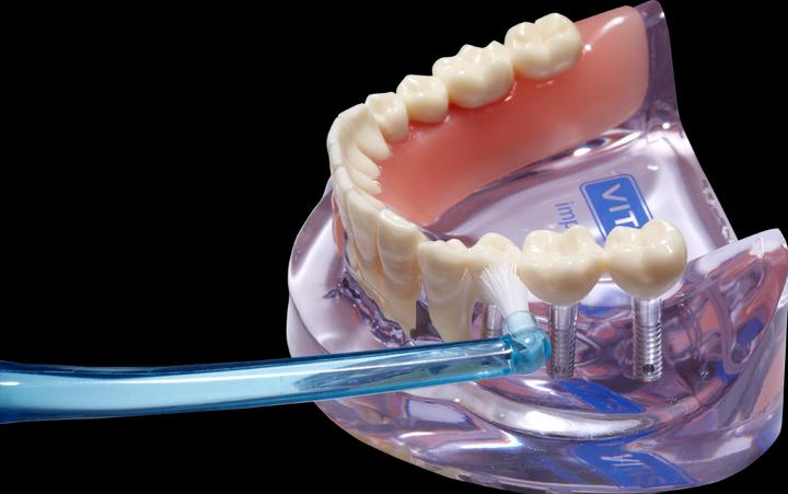 Produktbild Dentaid Vitis Implant Monotip Zb (1 x)
