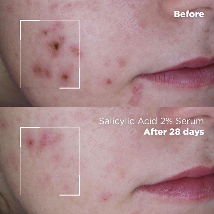 Immagine prodotto Skin Republic Acido salicilico 2% (30 ml)