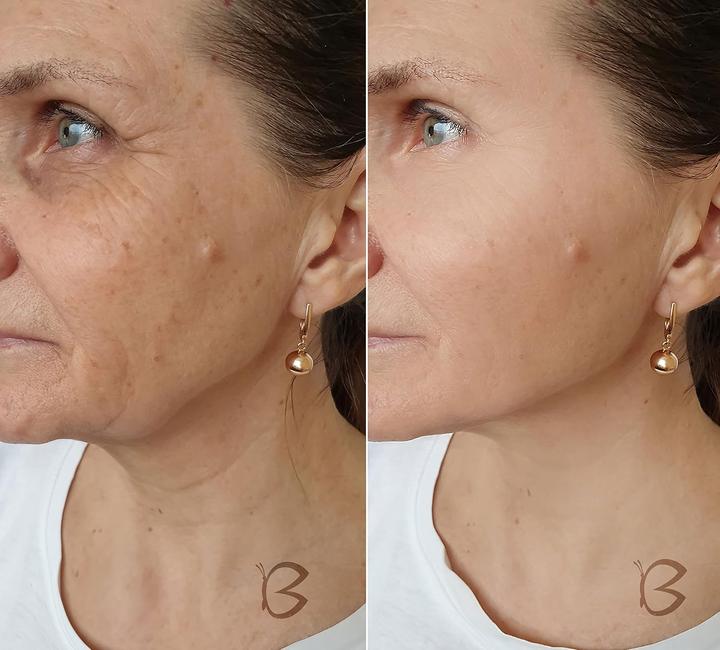Produktbild Beautifly B Meso