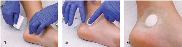 Actual product image IVF Hartmann plus Cavity wound pad (2112.26 ml)