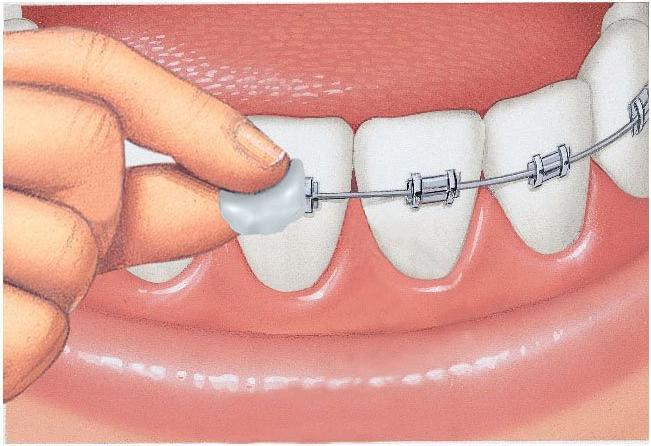 Produktbild GUM SUNSTAR Orthodontic Wachs