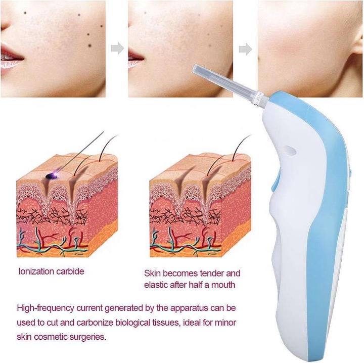 Produktbild Filfeel Muttermal Entferner