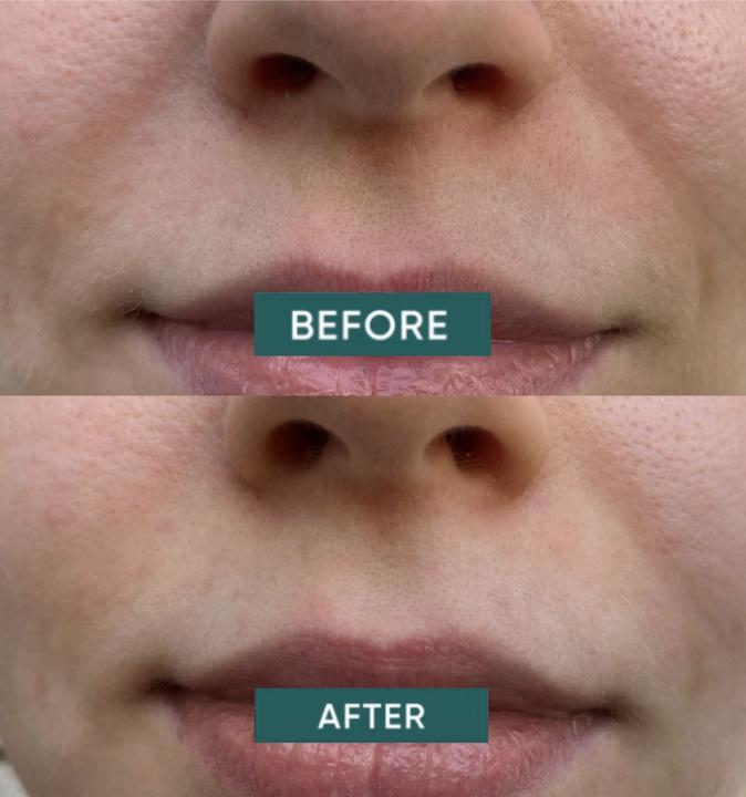 Produktbild Apricot Mouth Patches