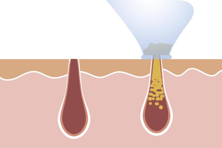 Produktbild MediaShop Derma Suction
