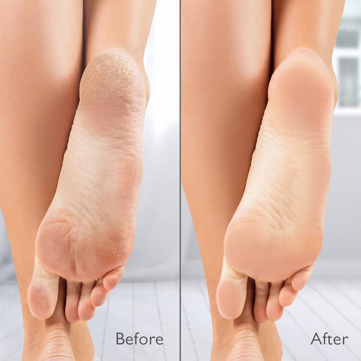 Actual product image Silk'n VacuPedi