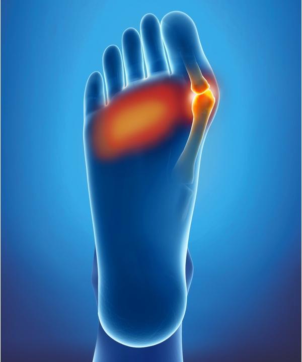Produktbild Epitact Doppelschutzkissen Hallux Valgus und schmerzende Fusssohlen Gr. L (L)