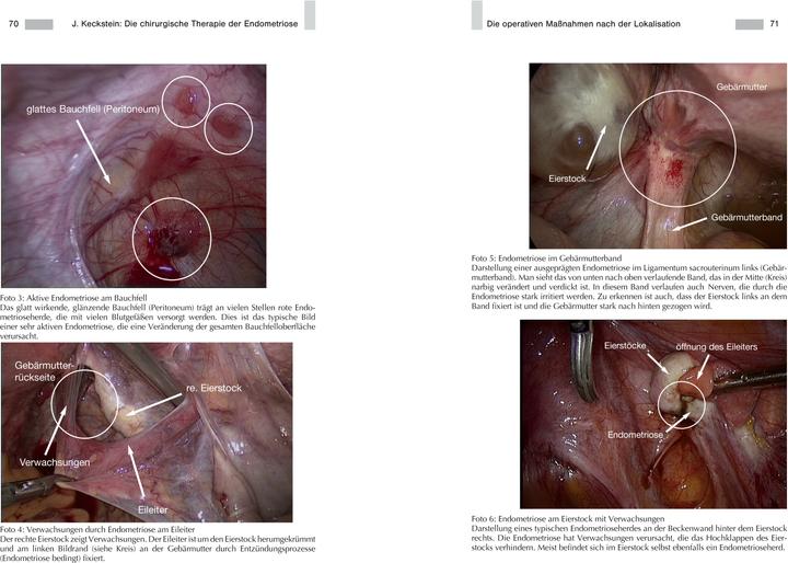 Produktbild Endometriose - Die verkannte Frauenkrankheit (Deutsch, Johanna Wolf, Prof. Dr. med. Jörg Keckstein, Dr. med. Anja Maria Engelsing, Prof. Dr. med. Gerhard Leyendecker, 2019)