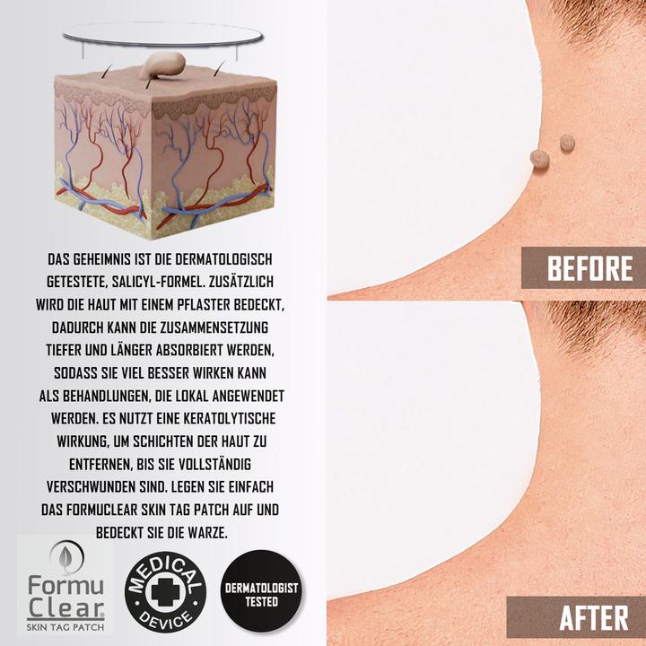 Actual product image Formu Clear Skin Tag Patch (Foot deodorant & powder)