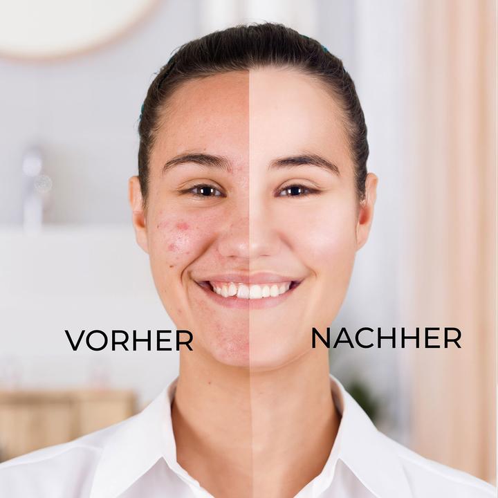 Actual product image Hermex Blackhead Remover (Blackhead remover)